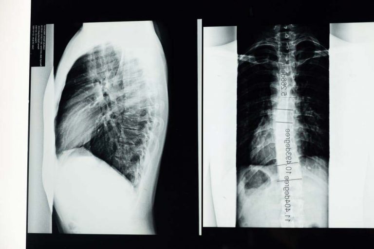 fibrosis-quistica-ancianos