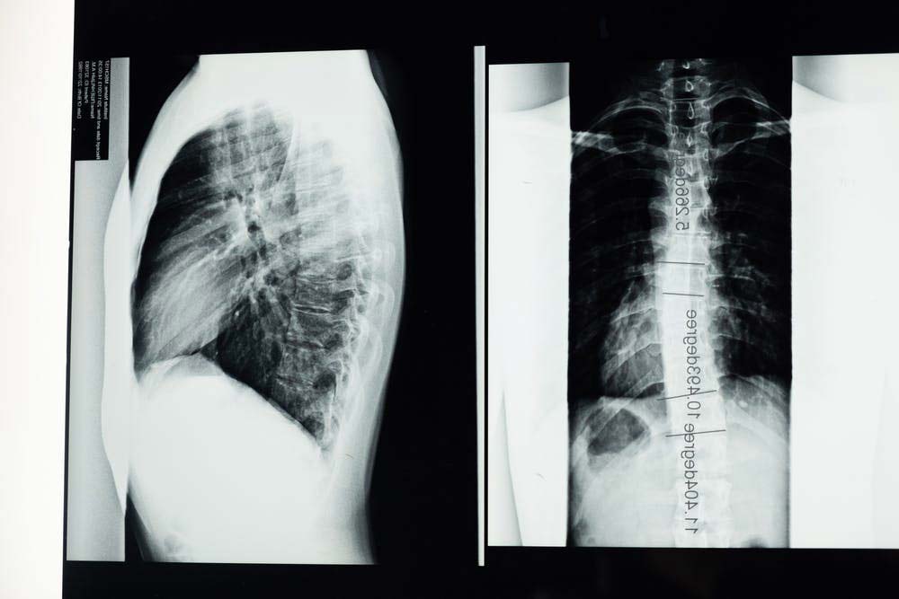 fibrosis-quistica-ancianos